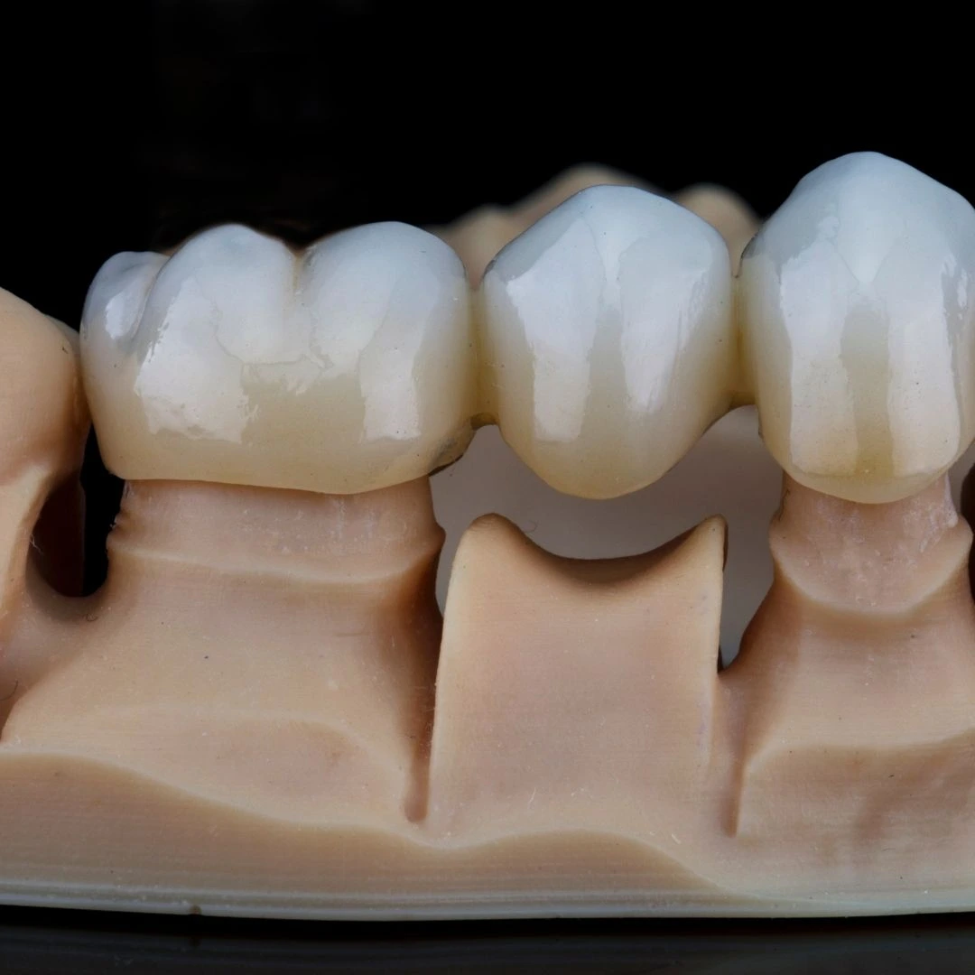 Close-up of a three-unit dental bridge showing the false tooth joined between two crowns
