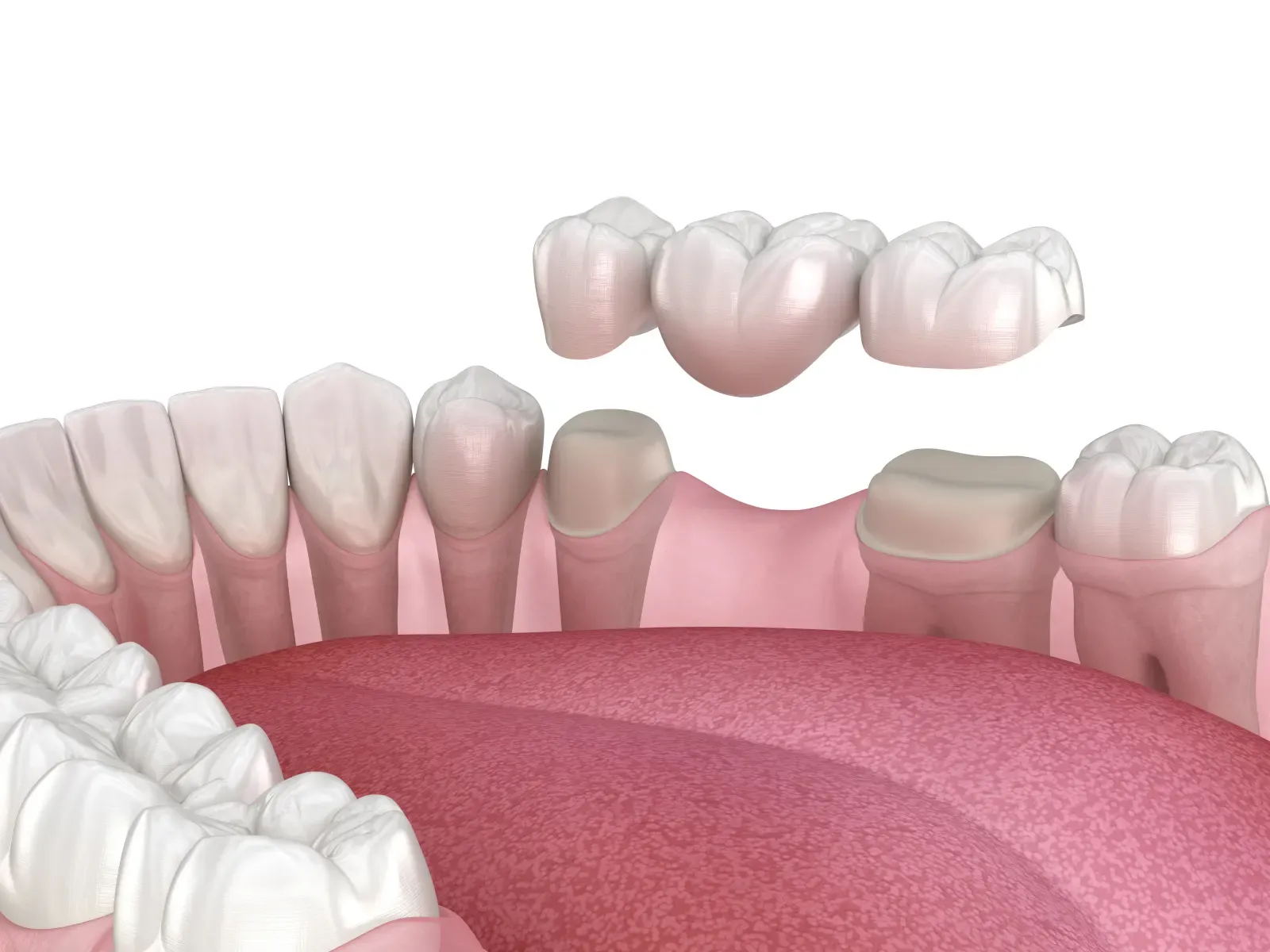 Illustration of a dental bridge being lowered over two prepared teeth on either side of a missing tooth gap