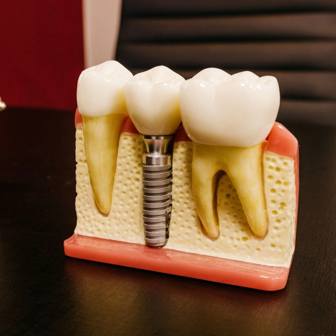 Dental model showing an implant post anchored in the jawbone beside natural teeth